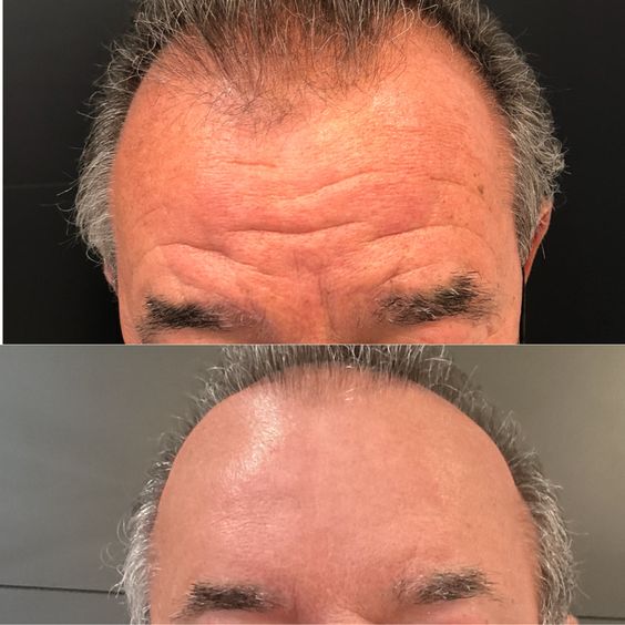 Botox Hombre