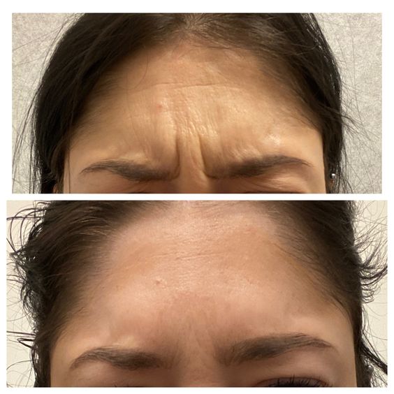 Botox