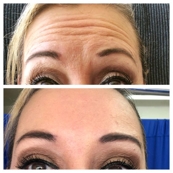 Botox