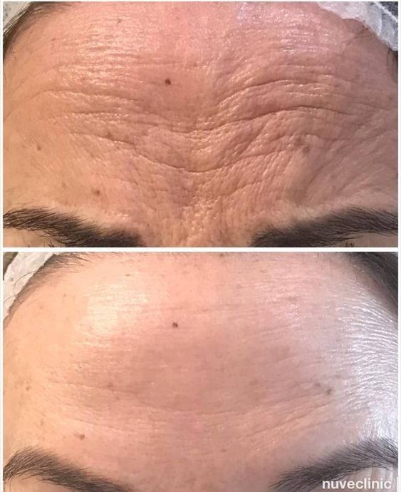 Botox