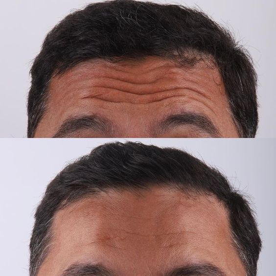Botox Hombre