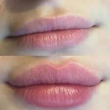 Relleno de Labios con Ácido Hialurónico
