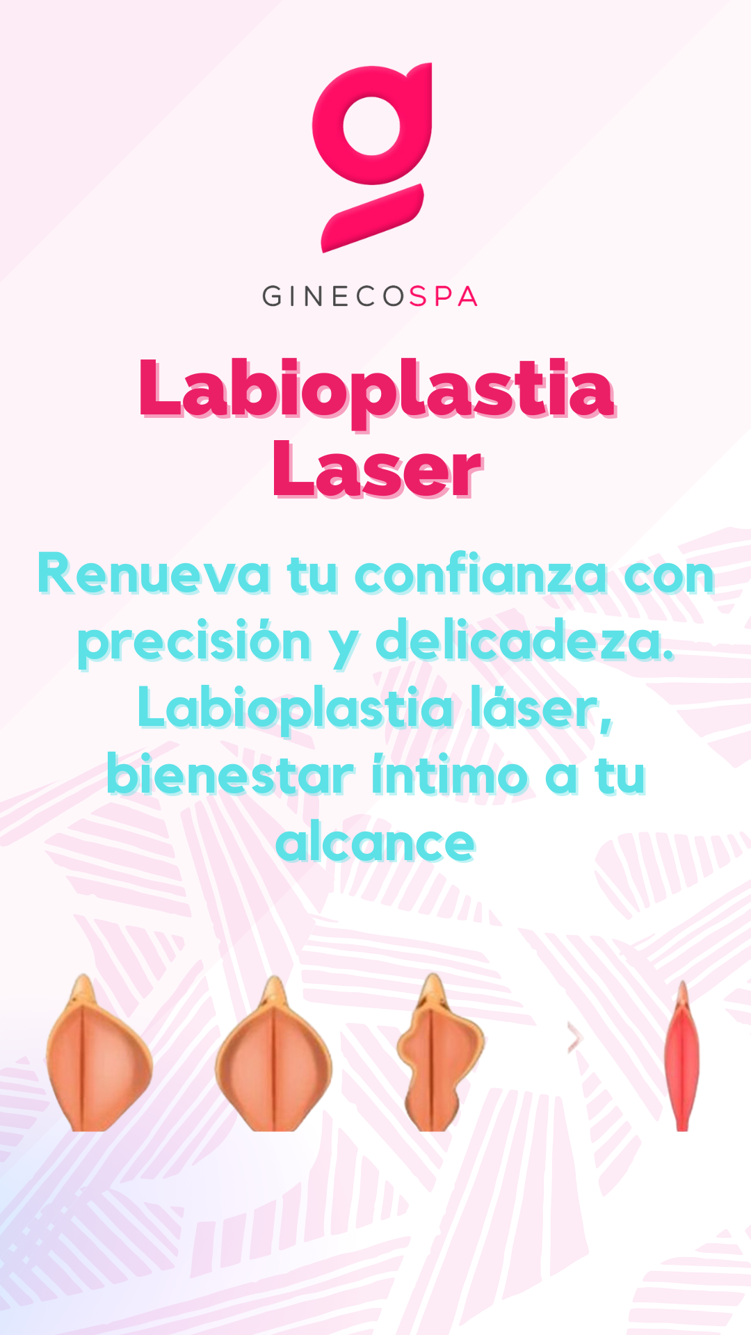 Labioplastia